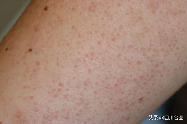 去医院能看好鸡皮肤吗