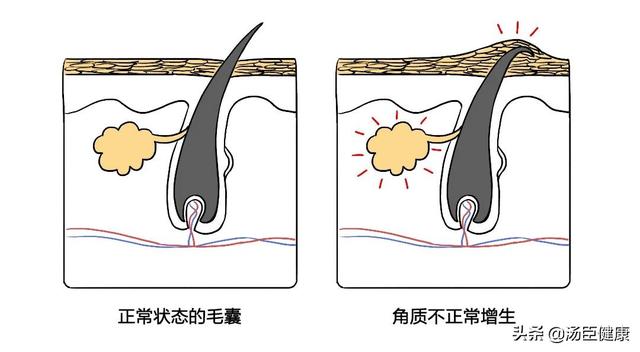 长鸡皮肤的人缺什么