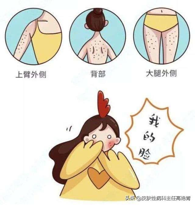 毛周角化脸红怎么治