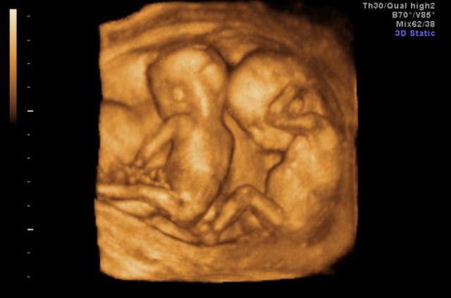 准妈妈显怀太早可能存在危险，了解原因后，保证自己安全地显怀