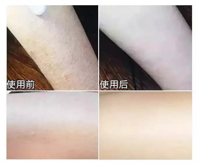 冬天局部皮肤瘙痒鸡皮