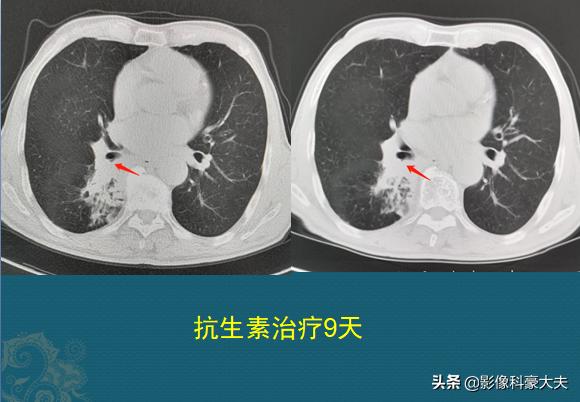 肺癌角化型鳞癌术后化疗
