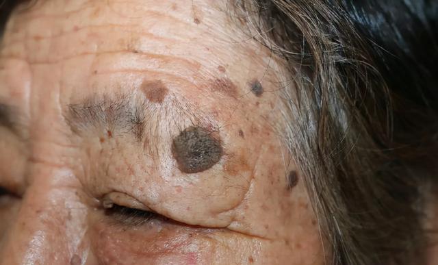 手点状角化与癌