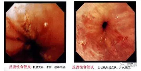 食管癌鳞癌角化型