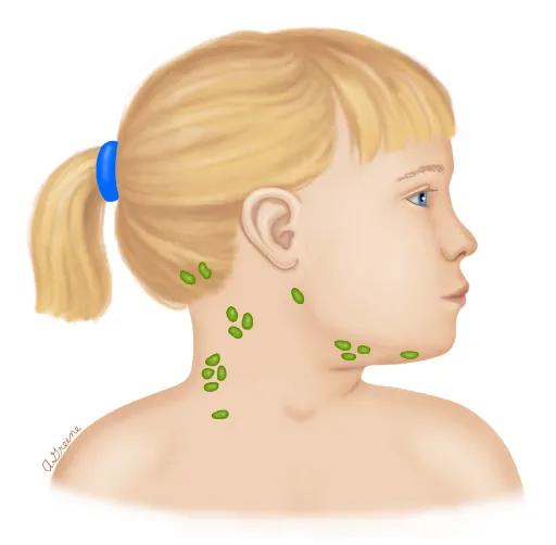 孩子脖子上摸到包块，警惕淋巴结异常肿大