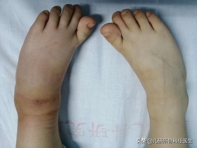 宝宝被蚊虫叮咬，爸爸妈妈莫惊慌，儿科医生告诉你如何处理