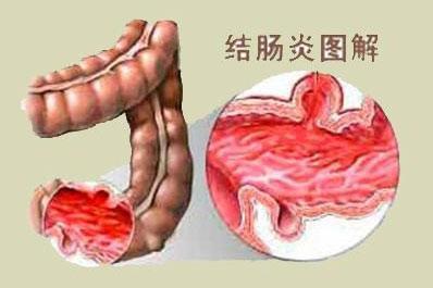 大便检查脓细胞三个加是什么意思