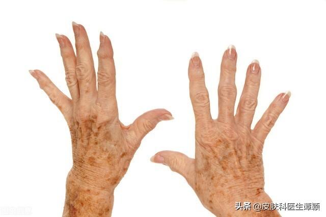 脂溢性角化冷冻治疗