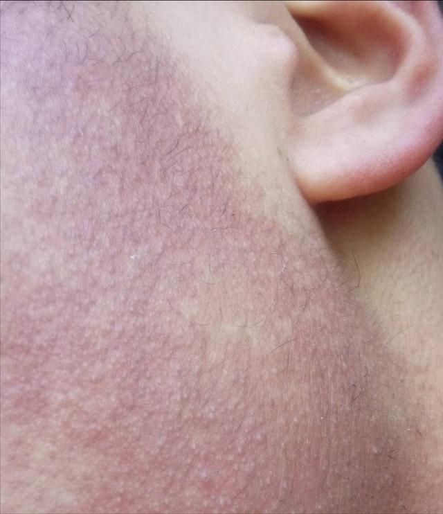 手脚上很多鸡皮疙瘩