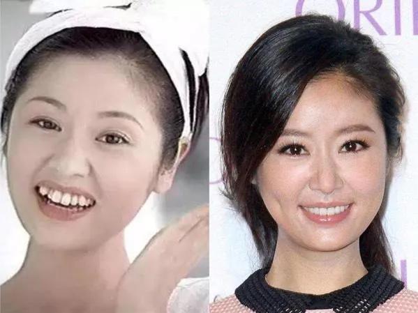 高圆圆整牙之前模样高圆圆没整牙以前照片