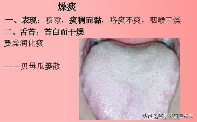 痰在肺则咳，痰在胃则呕！五种痰证的表现和治疗你知道多少？