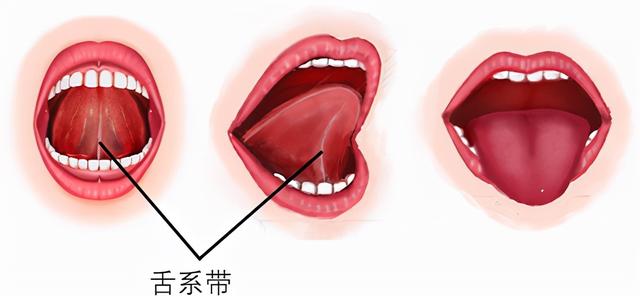 新生儿舌系带剪还是不剪？舌系带短有啥危害？