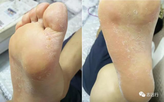 角化型手足癣用什么中药泡好