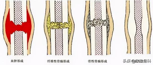 5周以上,此期骨折处淤血已基本吸收,治疗宜补,以促进更牢固的骨痂生成