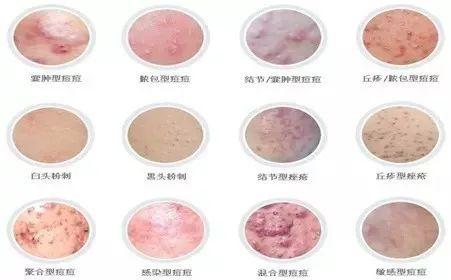 毛囊口上皮角化亢进是什么意思