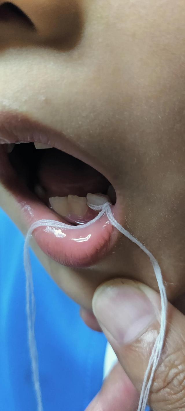 小朋友的牙可以这样拔？