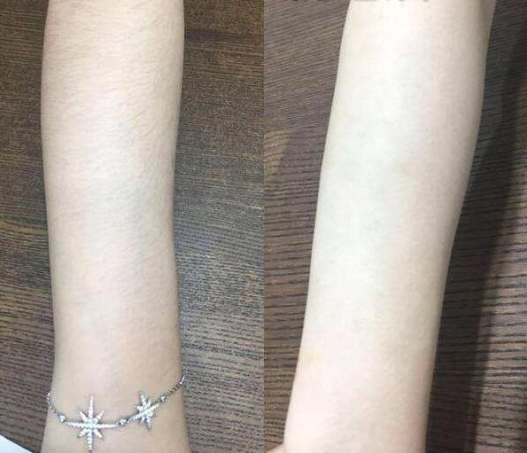 手背皮肤就长鸡皮一样