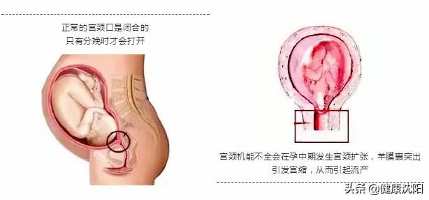健康科普堂 | 早产有先兆，孕妇应知道，超声可预测，医生来治疗