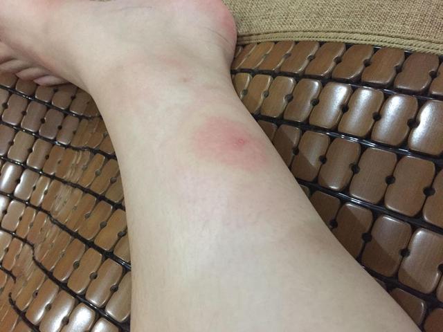 板层型鱼鳞病存活