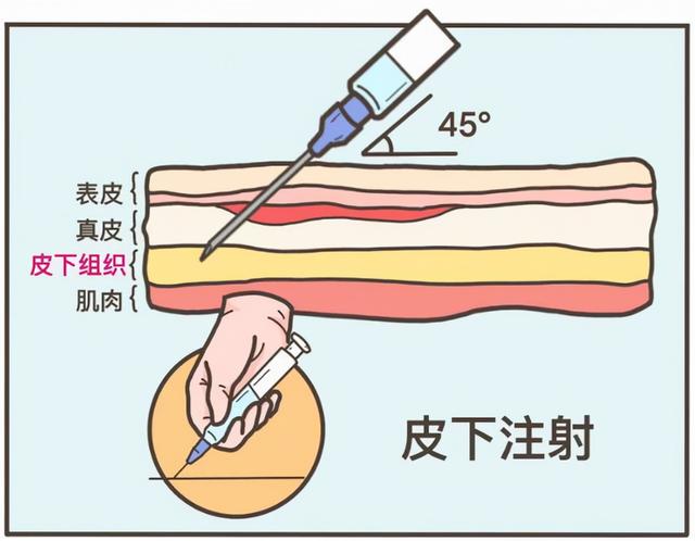 小孩打屁股吊针图片