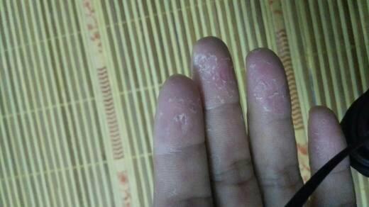 手蜕皮怎么办