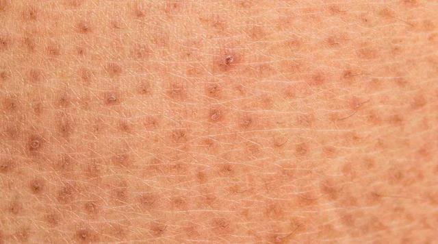 毛周角化症的多发季节