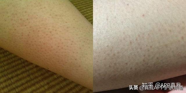 怎么打败鸡皮肤