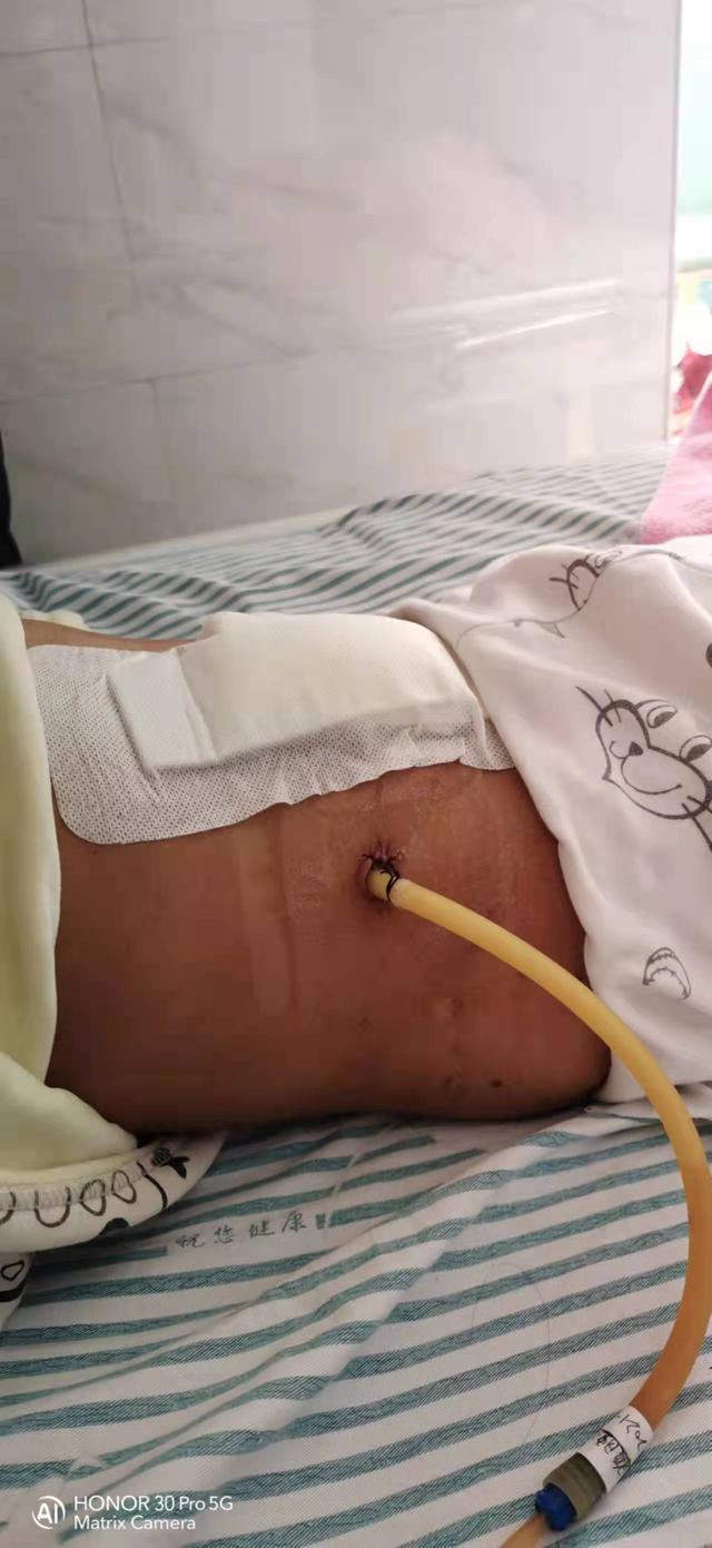 6岁小孩得阑尾炎，你怎么看？