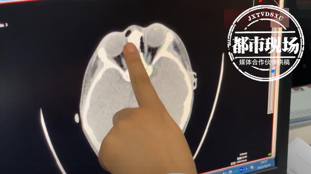 想想都疼！3岁女童不慎摔倒，筷子戳进鼻子断成两截