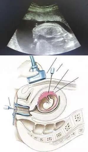 说说痛苦的绒毛穿刺的经历吧，希望给有需要的姐妹一点经验