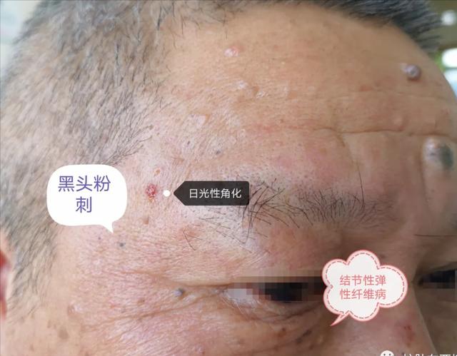 肥厚性日光性角化症