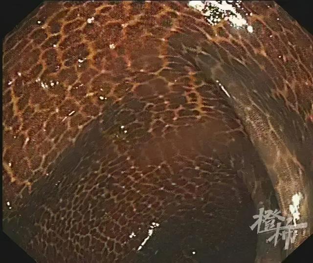 热搜第一！吃了三年酵素，阿姨肠子表面变成“蛇皮”？网友：密集恐惧症犯了