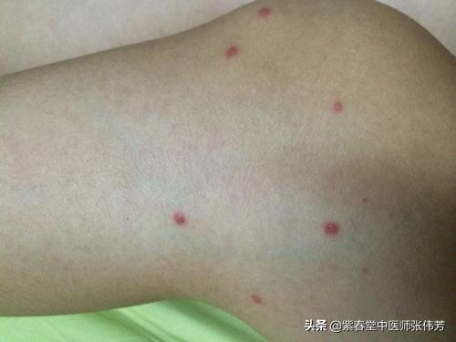 手臂上突然有很多小红点
