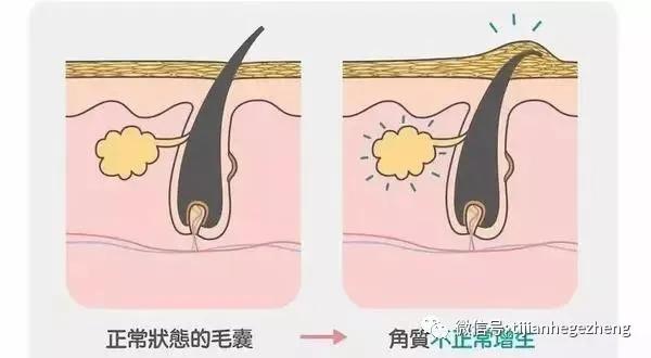 毛囊过度角化飞行员