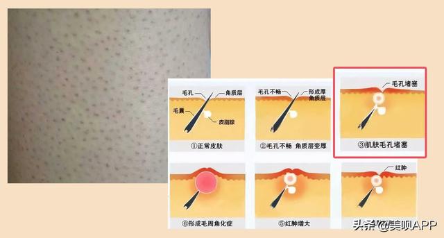 角质鸡皮肤做手术