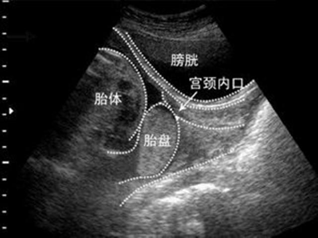 检查副胎盘什么意思