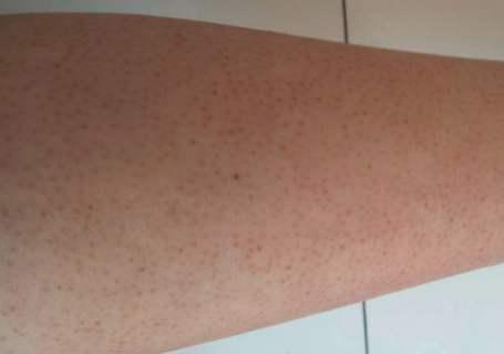 美加净身体乳擦身体会不会致痘