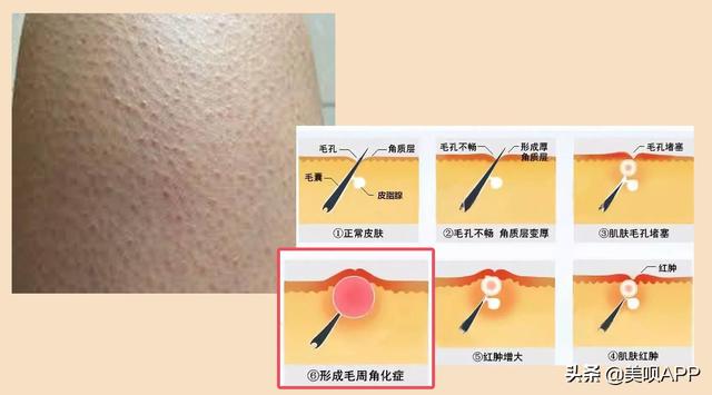 毛囊角化症与毛周角化症的区别