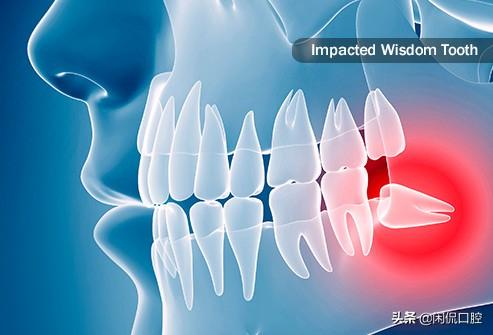 智齿发炎怎么办 智齿发炎怎么办（怀孕智齿发炎怎么办） 科普