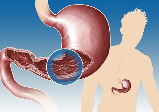 吃香蕉是养胃还是伤胃？提醒：不想胃受伤，尽量少吃这3物