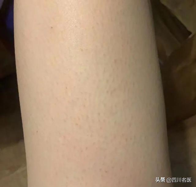 毛周角化症要看医生吗