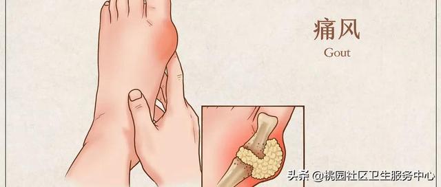 啤酒＋海鲜＝痛风套餐？真相来了！四招解决尿酸居高不下