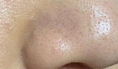 鼻子周围的毛周角化