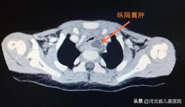 省儿童医院的紧急通知，一月内3例！警惕隐形“食管异物”