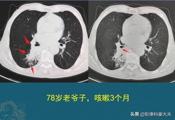 肺癌角化型鳞癌术后化疗
