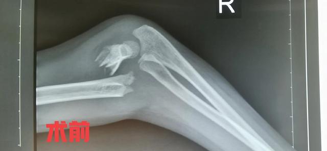 小儿肱骨髁上骨折小知识