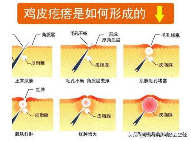 萎缩性红毛发角化症