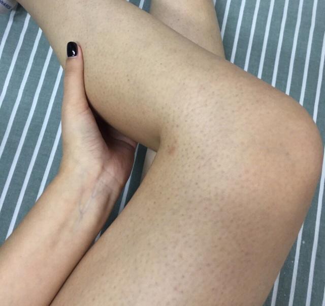 维a酸乳膏可以去除鸡皮肤吗