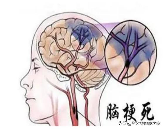 老年人预防脑梗与老年痴呆，如何补充叶酸与B12很重要，请看此文