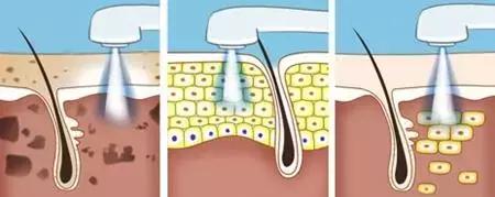 汗孔角化症能治愈吗